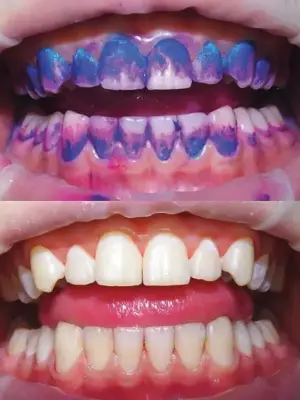 Biofilm display importance