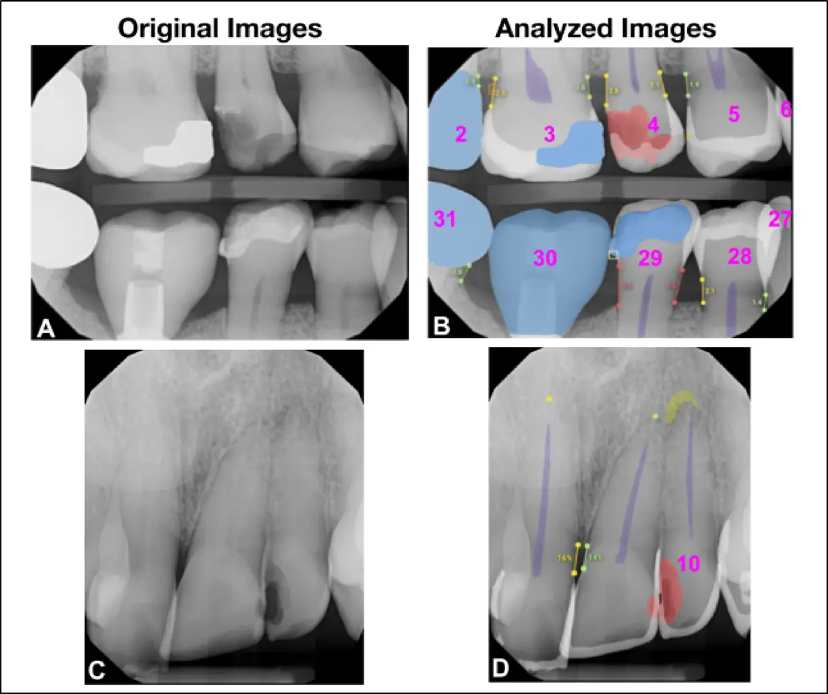 Predict AI - Cavity Progression Simulation